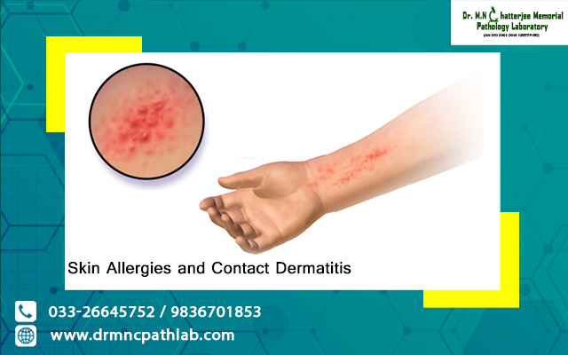 Skin Allergies and Contact Dermatitis