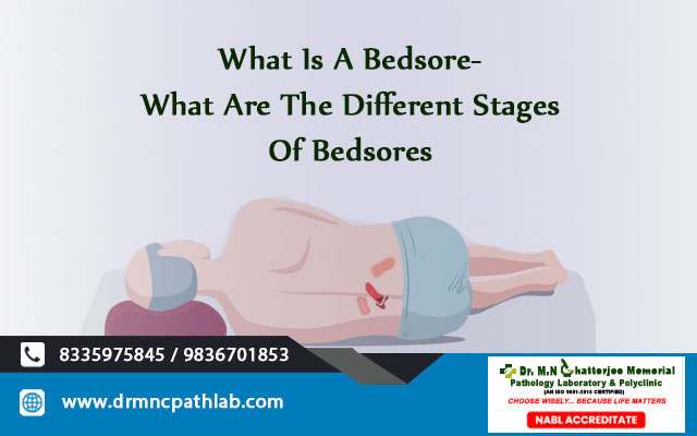 What Is A Bedsore- What Are The Different Stages Of Bedsores